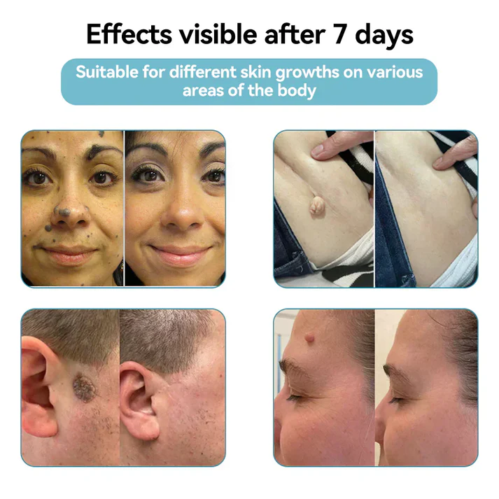 Oceahade™ All-in-One CO₂ Laser Eraser Pen | Removes Moles, Warts, Skin Flaws & Pigmentation