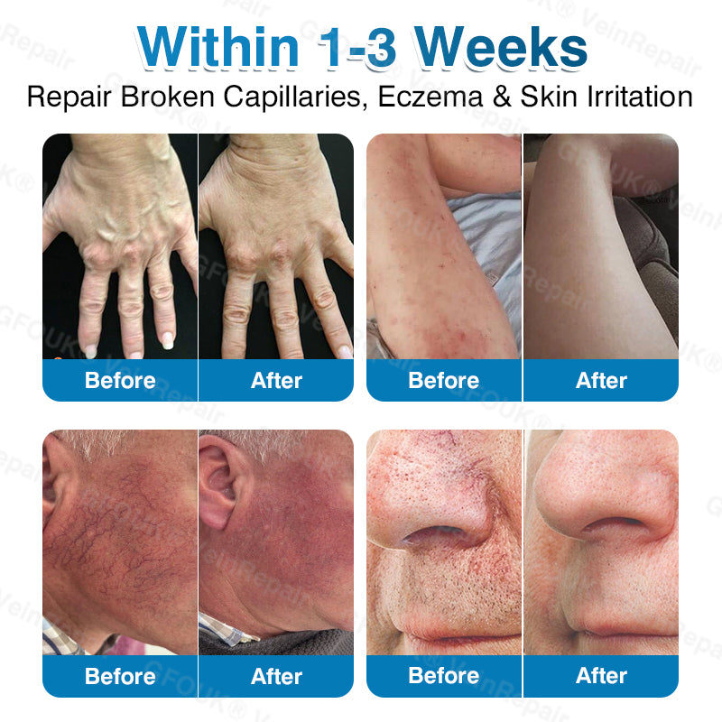 🇺🇸🏆✅️🏃LUMIVO™VeinRepair Microneedle Patch Roll⚡Instant Relief, Long-Term Results