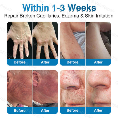 🇺🇸🏆✅️🏃LUMIVO™VeinRepair Microneedle Patch Roll⚡Instant Relief, Long-Term Results