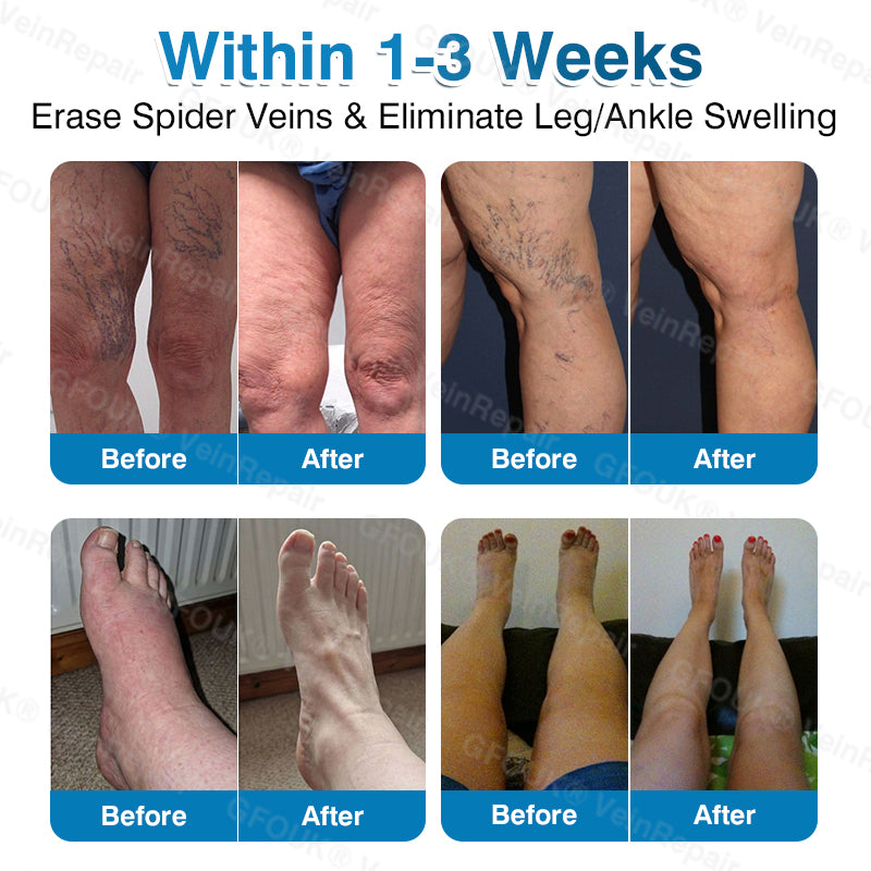🇺🇸🏆✅️🏃LUMIVO™VeinRepair Microneedle Patch Roll⚡Instant Relief, Long-Term Results