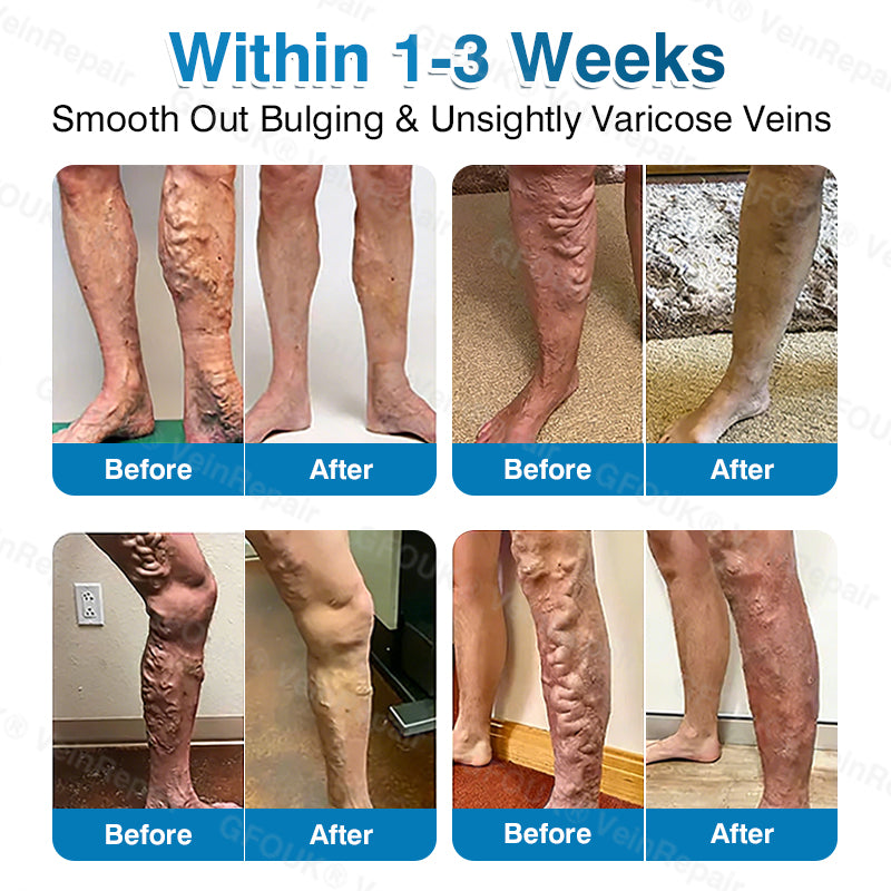 🇺🇸🏆✅️🏃LUMIVO™VeinRepair Microneedle Patch Roll⚡Instant Relief, Long-Term Results
